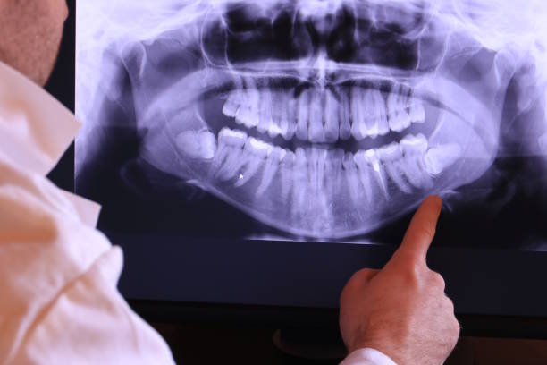 Best Emergency Wisdom Teeth Removal in Prineville, OR